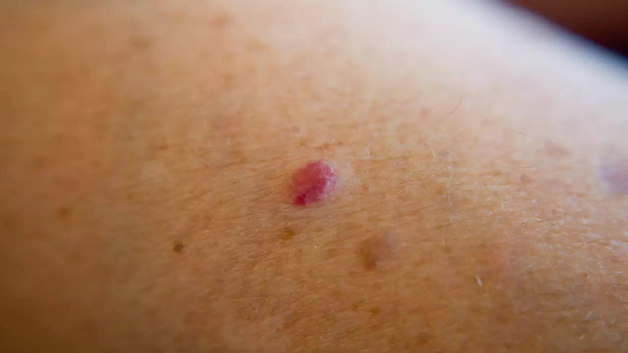 Puntos rojos en la piel: descubre por qué salen y cómo eliminarlos